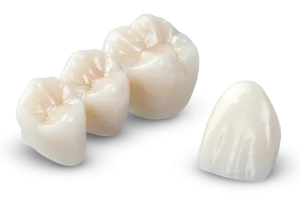 bezmetalne krunice Banja Luka primjer