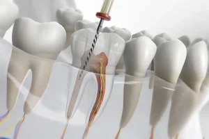 endodoncija banja luka tretman zuba