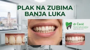 plak na zubima Banja Luka