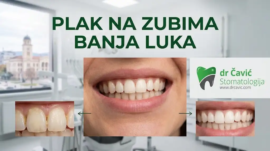 plak na zubima Banja Luka